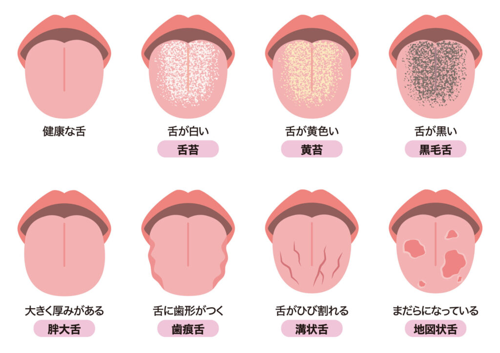 舌苔のイメージイラスト